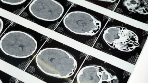 Serie de escaneres cerebrales sobre negatoscopio, usados en los estudios de neuroimagen sobre cannabis